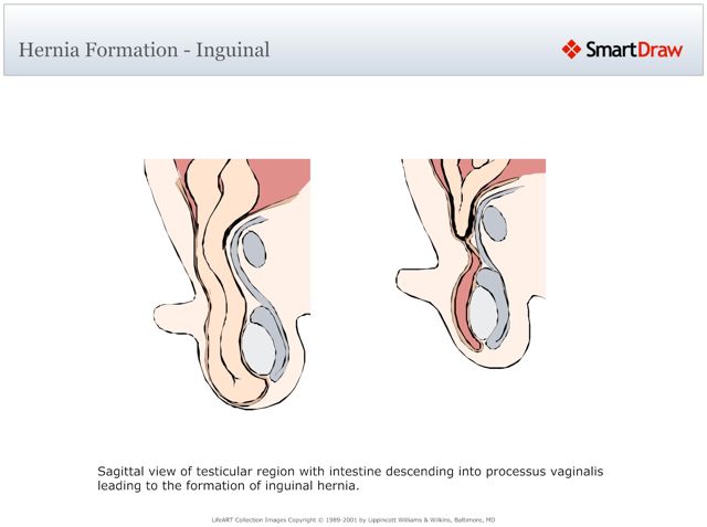 Hernia_Formation_-_Inguinal