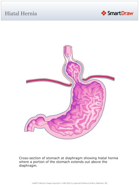 Hiatal_Hernia