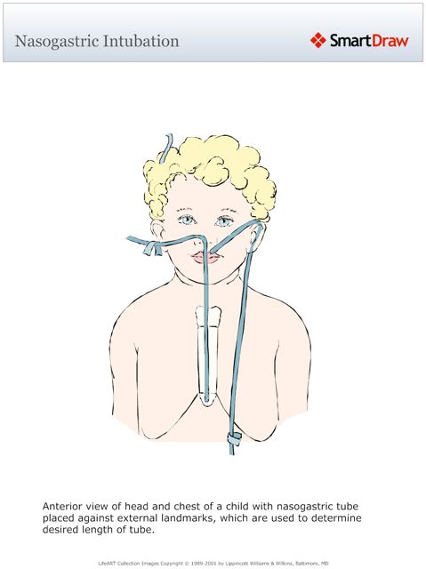 Nasogastric_Intubation