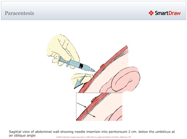 Paracentesis