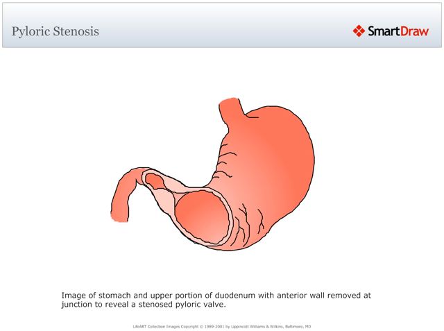 Pyloric_Stenosis