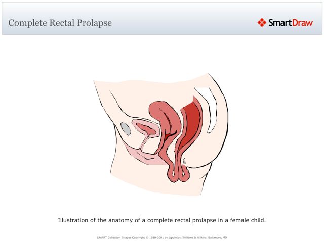 Complete_Rectal_Prolapse