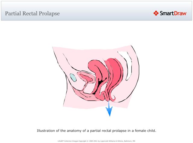 Partial_Rectal_Prolapse