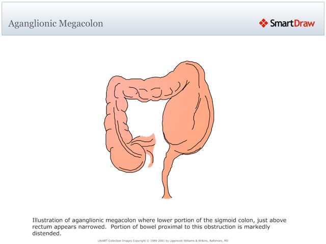 Aganglionic_Megacolon