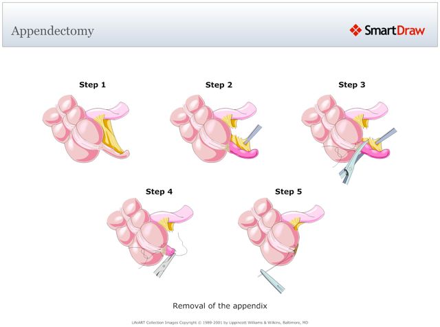 Appendectomy