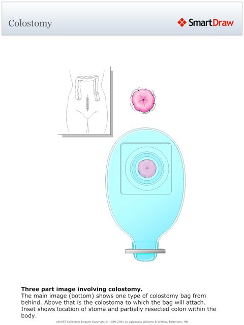 Colostomy