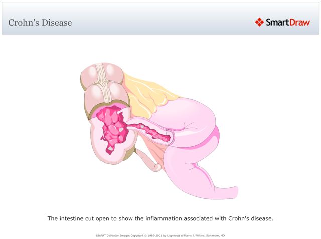 Crohn's_Disease