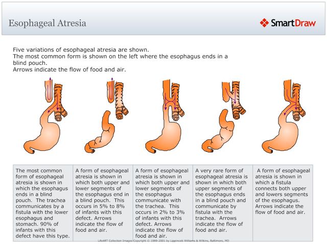 Esophageal_Atresia