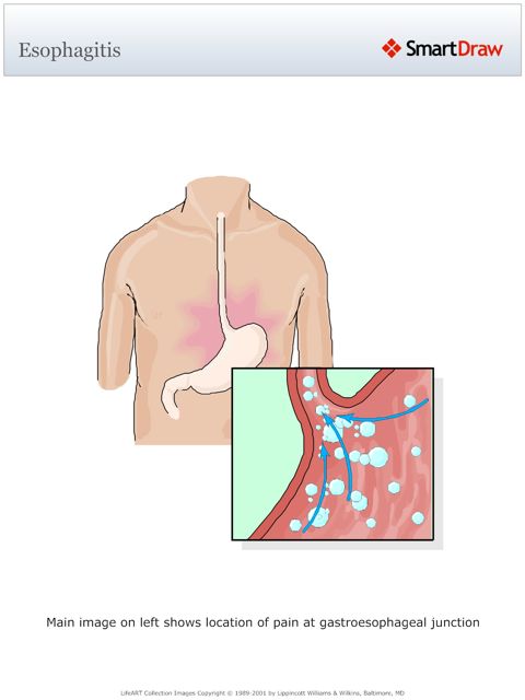 Esophagitis