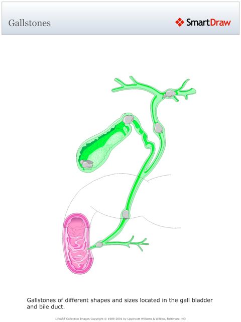 Gallstones
