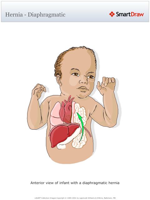 Hernia_-_Diaphragmatic