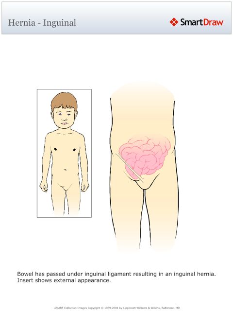 Hernia_-_Inguinal