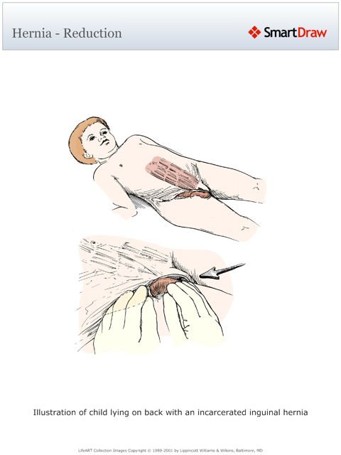 Hernia_-_Reduction