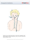 Nasogastric_Intubation