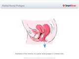Partial_Rectal_Prolapse