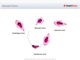 Stomach_Ulcers2