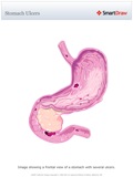Stomach_Ulcers3
