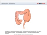 Aganglionic_Megacolon