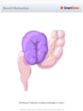 Bowel_Obstruction