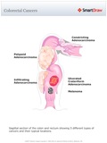 Colorectal_Cancers