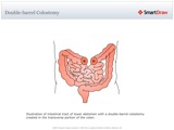 Double-barrel_Colostomy