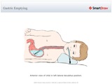 Gastric_Emptying