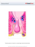 Hemorrhoid