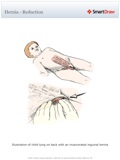 Hernia_-_Reduction